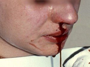 Dengue-comum-e-hemorragica-sangramento